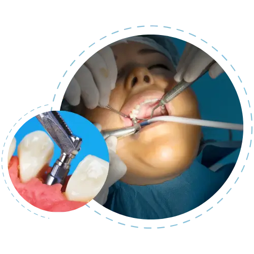 al-on-four-ve-all-on-six-implantlar