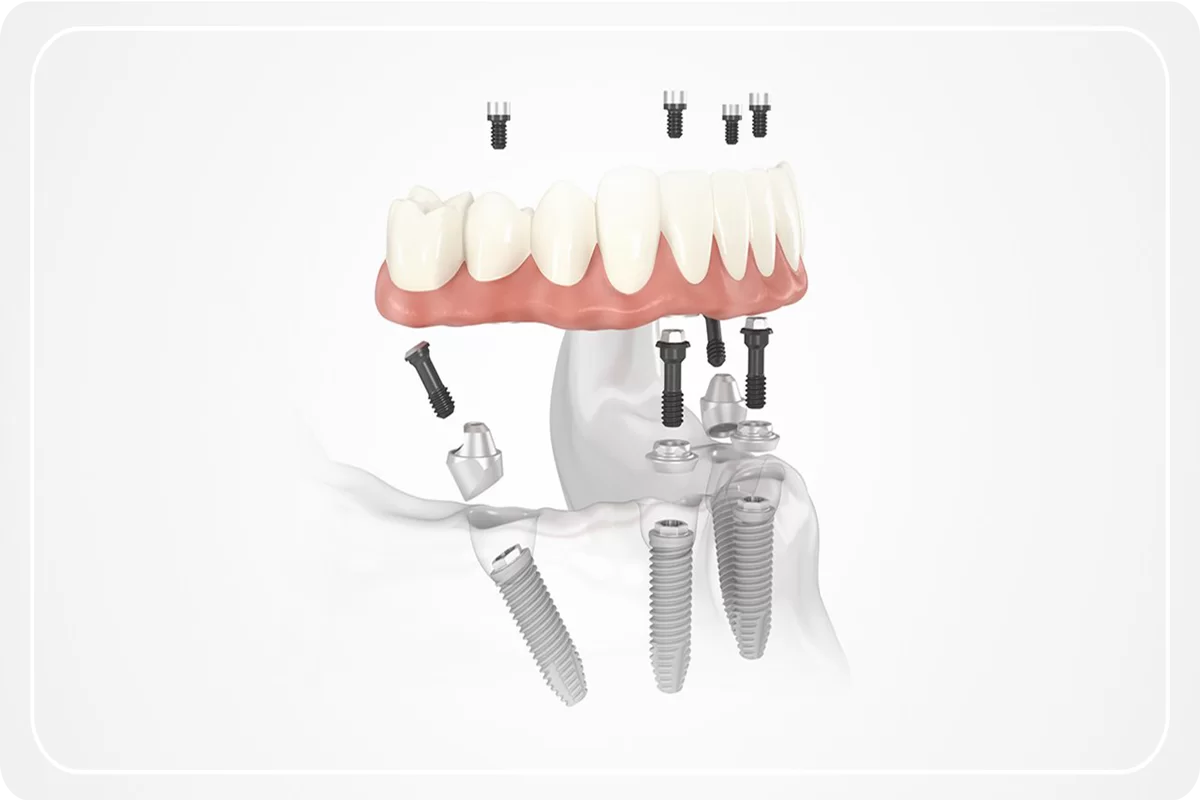 all-on-four-implant.png All On Four İmplant