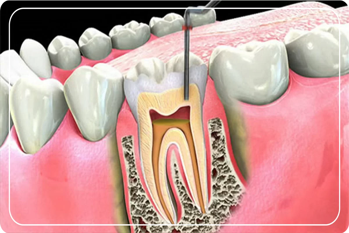 endodonti-kanal-tedavisi-omer-bayar.png