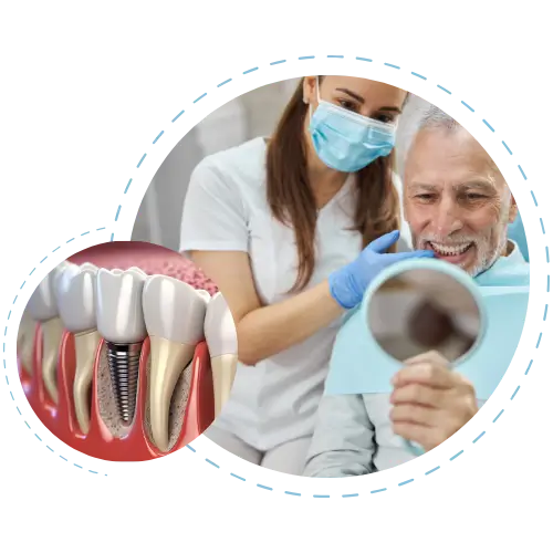 full-mounth-implantlar