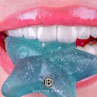 emax veneer gülüş tasarımı12