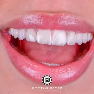 emax veneer gülüş tasarımı13