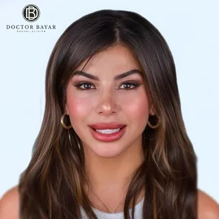 emax veneer gülüş tasarımı18