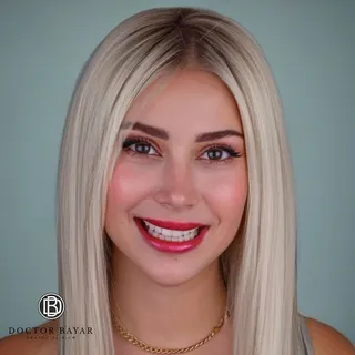 emax veneer gülüş tasarımı19