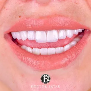 emax veneer-gülüş tasarımı2