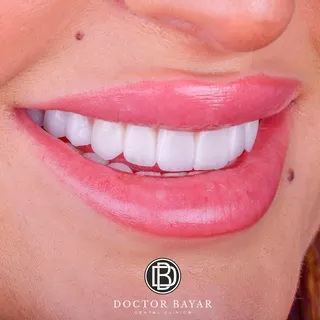 emax veneer-gülüş tasarımı3