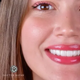 emax veneer-gülüş tasarımı5